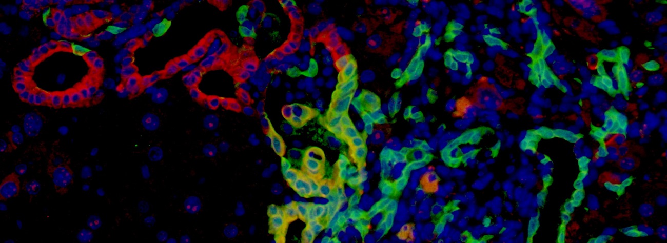 bile duct cancer in mice